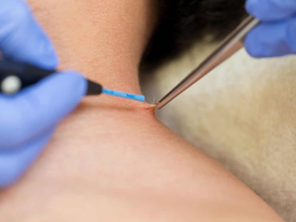 Удаление бородавки лазером