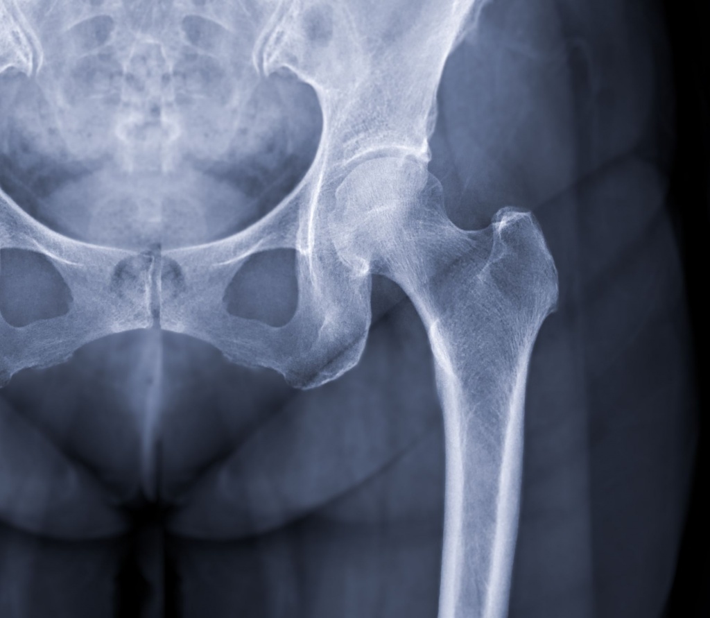 Рентген кульшового суглоба