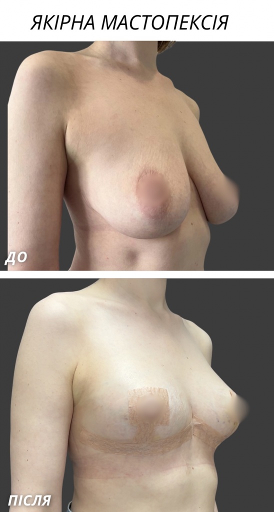 Якірна мамопластика