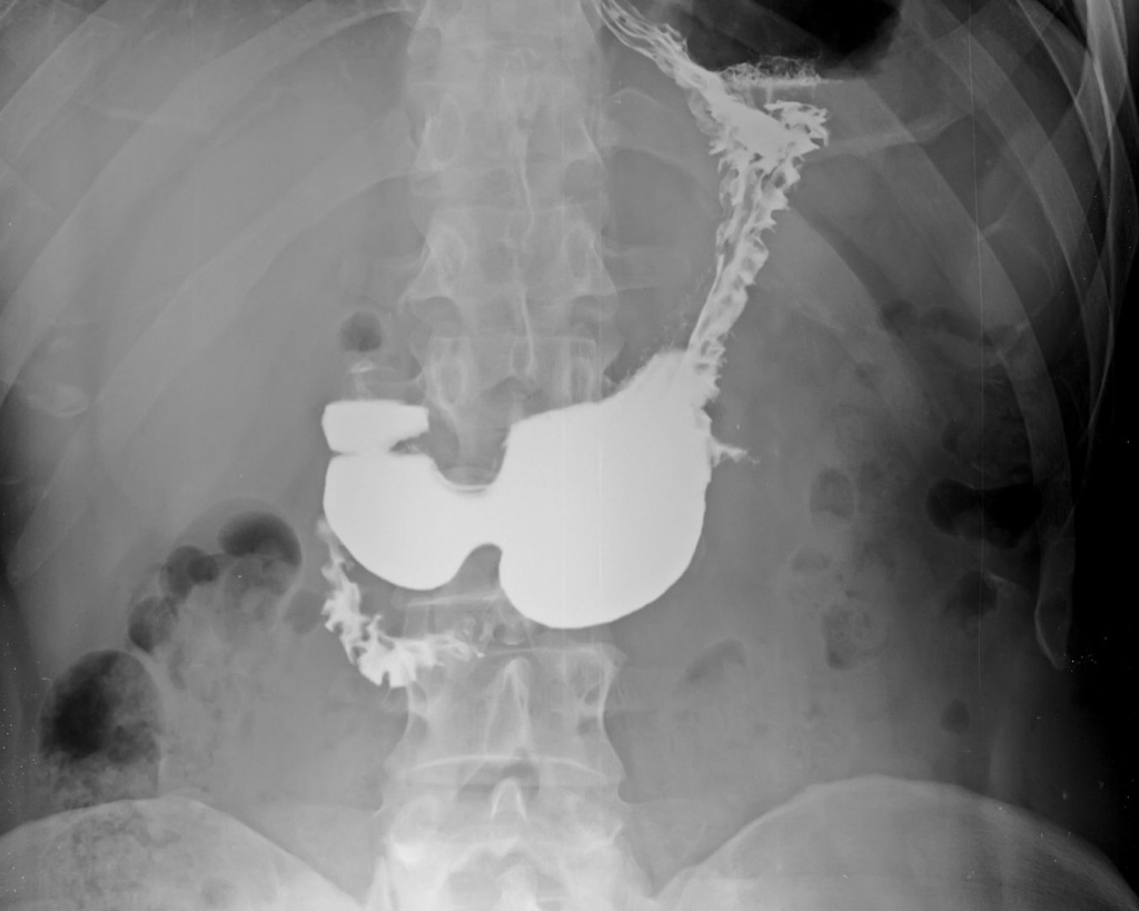 Рентген верхнього відділу ШКТ