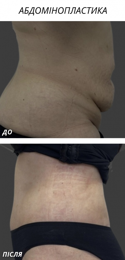 Абдомінопластика