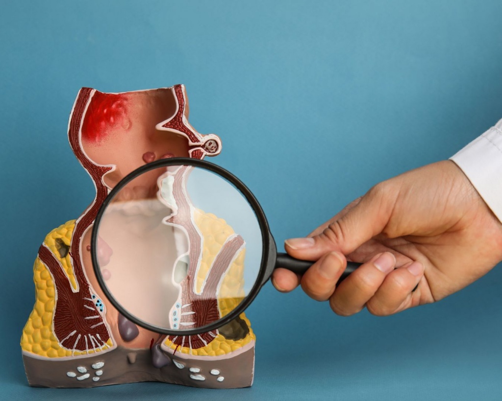 Коли треба проктолог