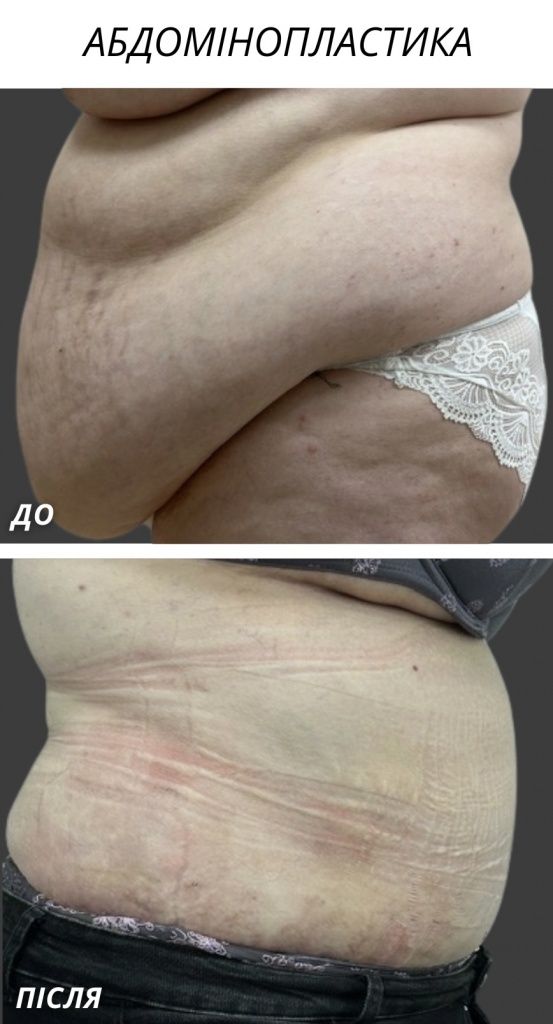 Абдомінопластика
